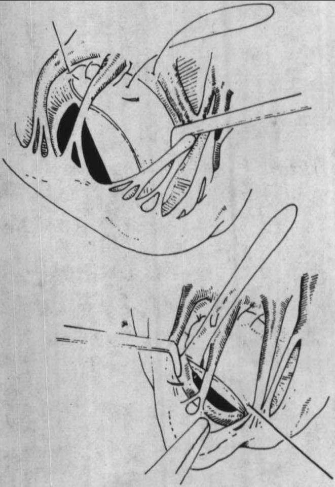 隔瓣后型VSD修補(bǔ)術(shù)